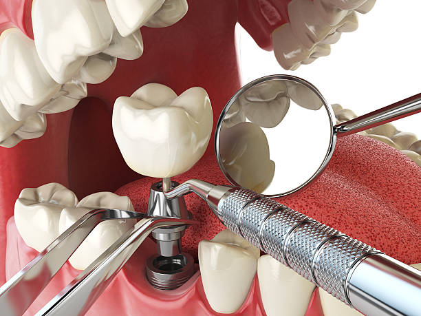 Best Emergency Treatment for Dental Infections or Abscesses in Huntington Bay, NY